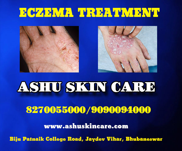 best eczema treatment clinic in bhubaneswar near capital hospital